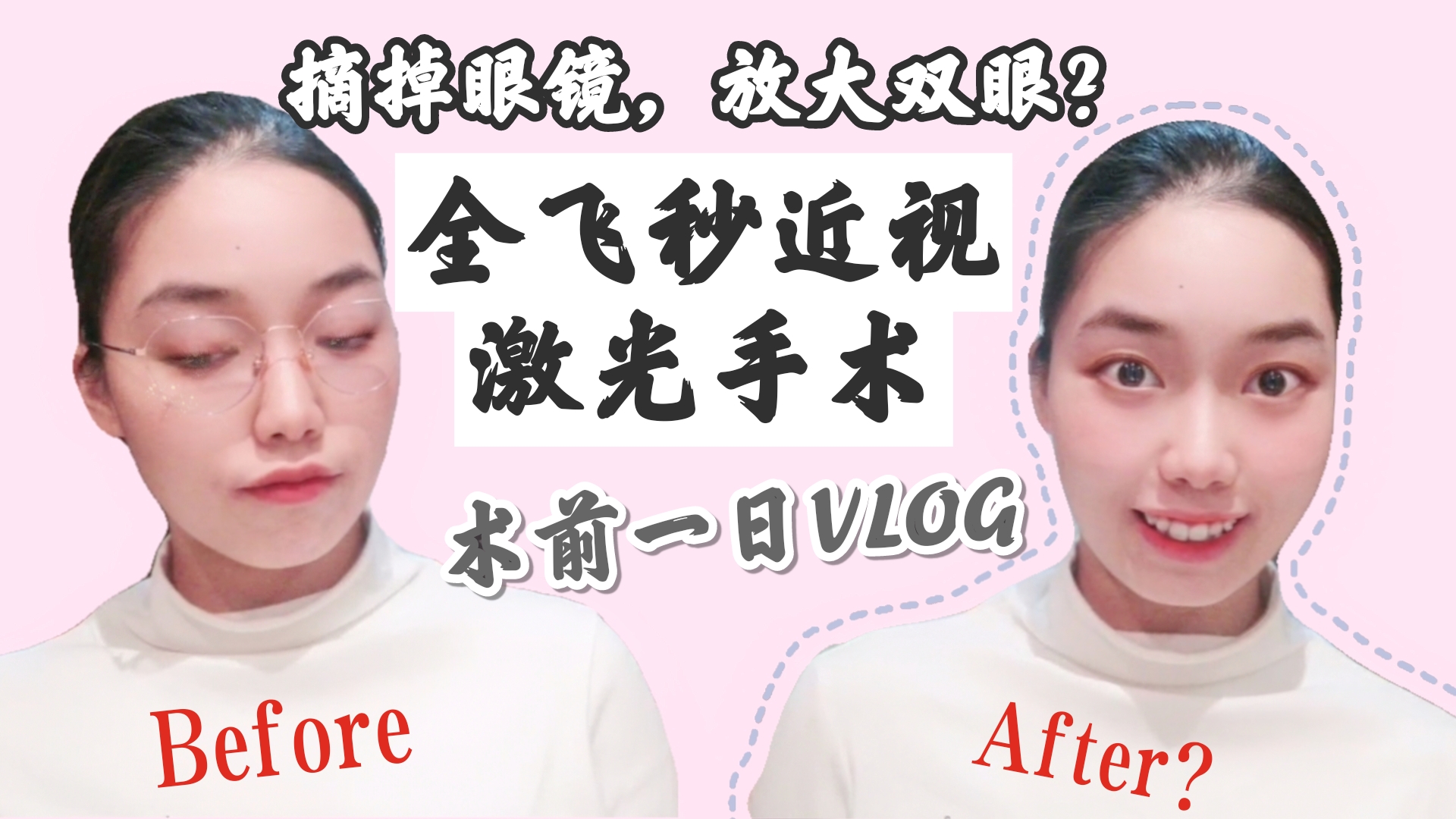 VLOG|摘掉眼镜!全飞秒近视激光手术术前一日记录|近视散光手术Q&A